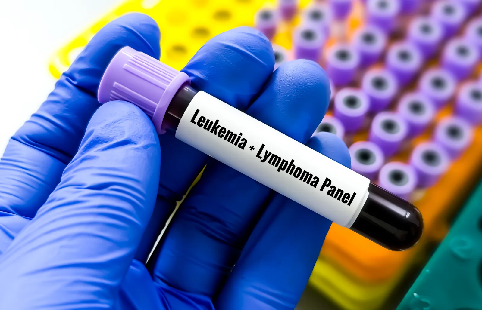 A stock image shows a blood sample for a leukemia test.