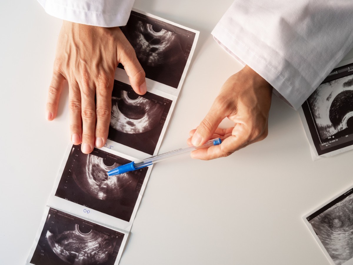 Condition Affecting Millions of Women Studied for Possible Dementia Link