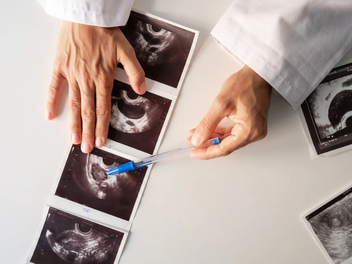 Doctor examines ultrasound scans showing possible polyendocrine metabolic ovarian syndrome (PMOS).