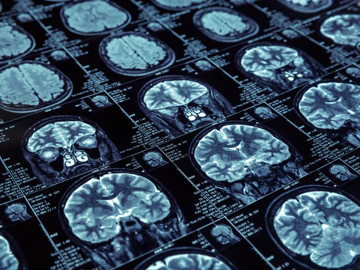 A close-up of magnetic resonance imaging of the brain is seen.